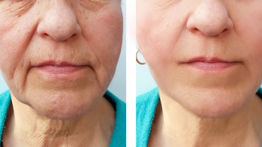 Dermal Fillers and Cheek Enhancements